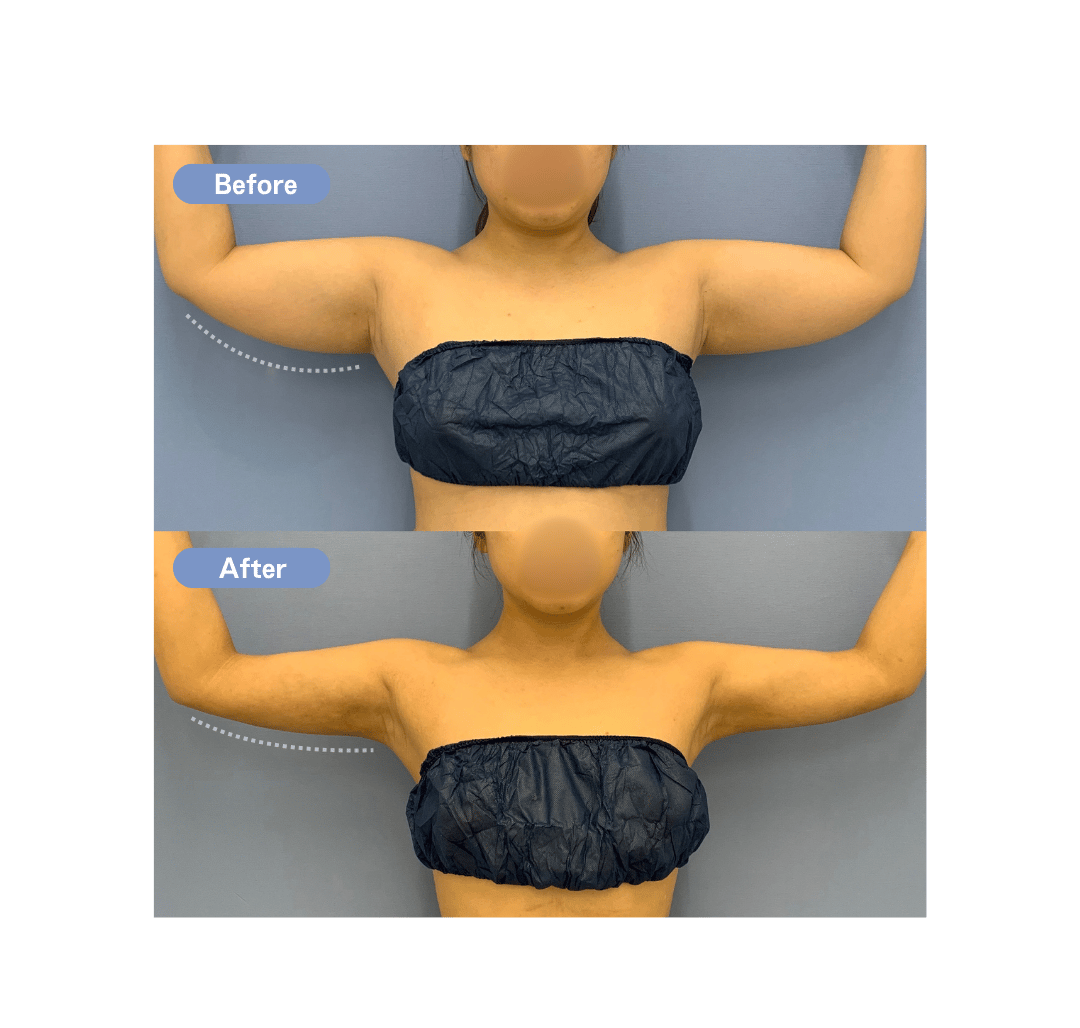ベイザー脂肪吸引 BODY 症例写真