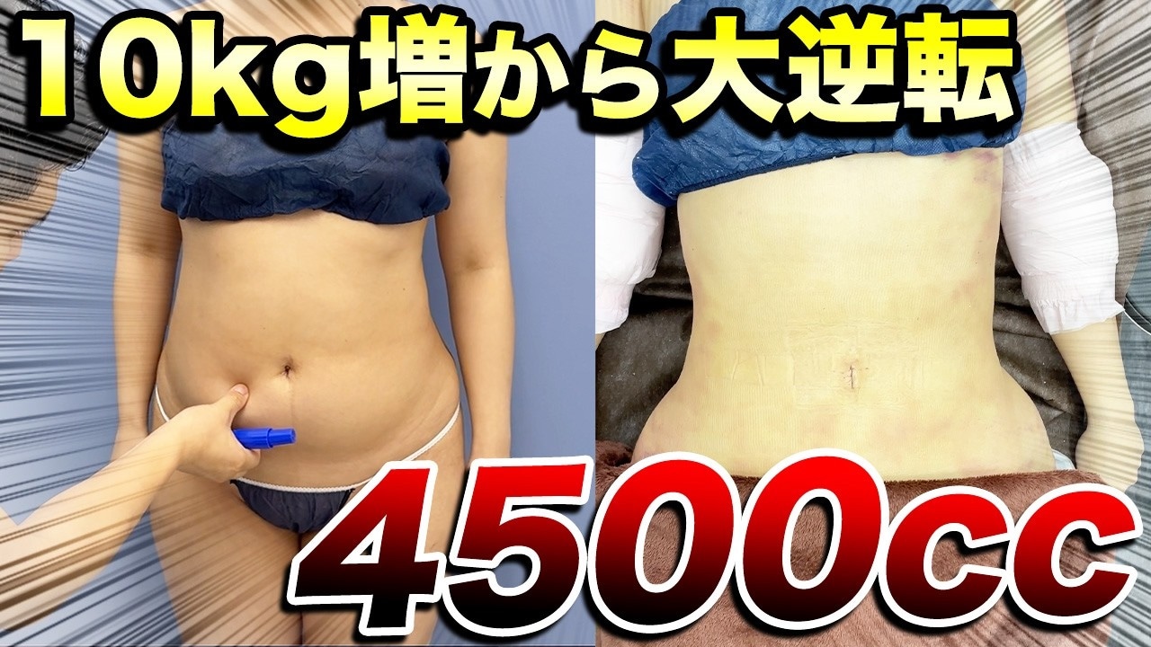 お腹の脂肪吸引ダウンタイムはつらい?1週間のリアルな経過に密着