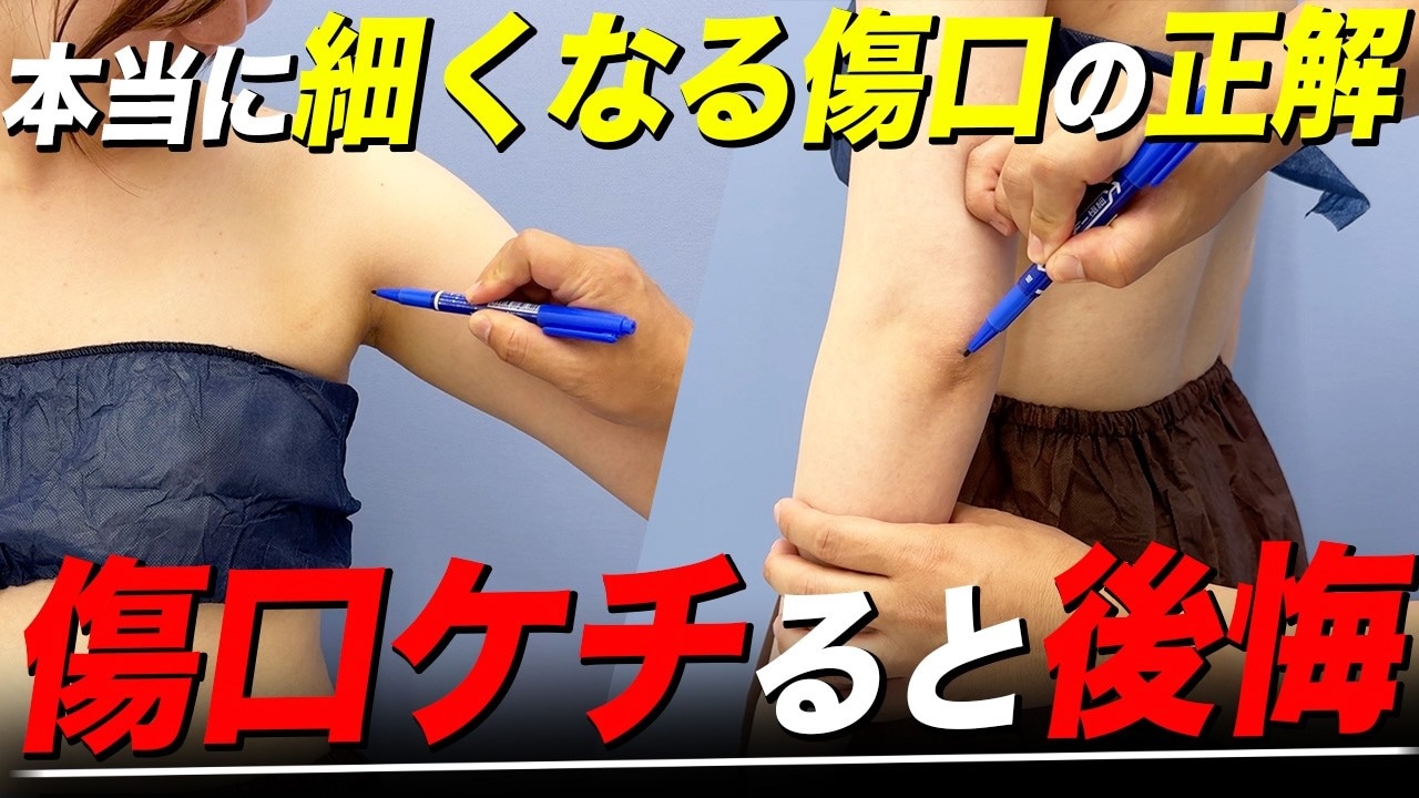 二の腕脂肪吸引の傷跡はどこに作るのが正解？位置と数で満足度が変わる！