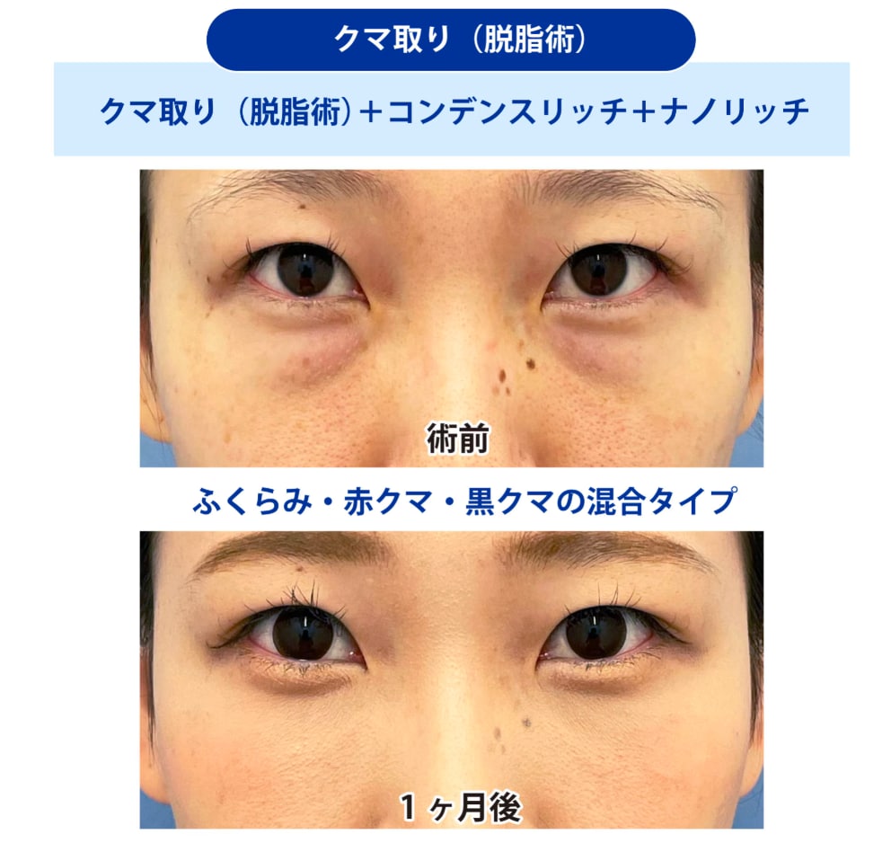 目の下の切らないクマ・たるみ取り 症例写真