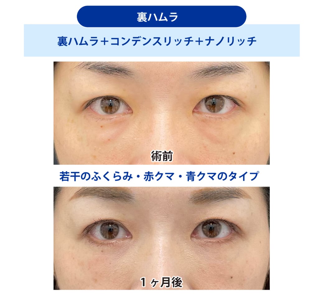裏ハムラ法 症例写真