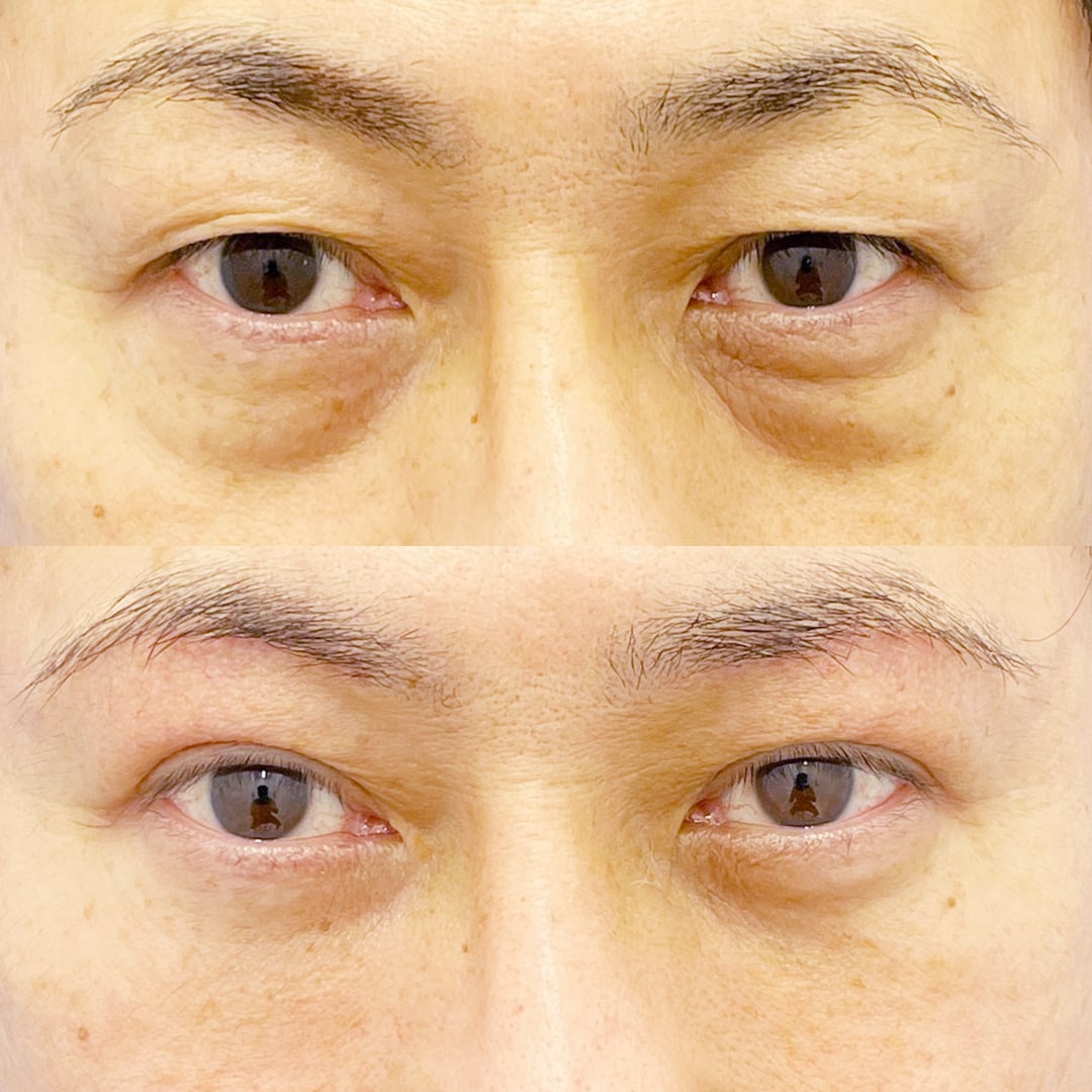 眉下リフト 症例写真