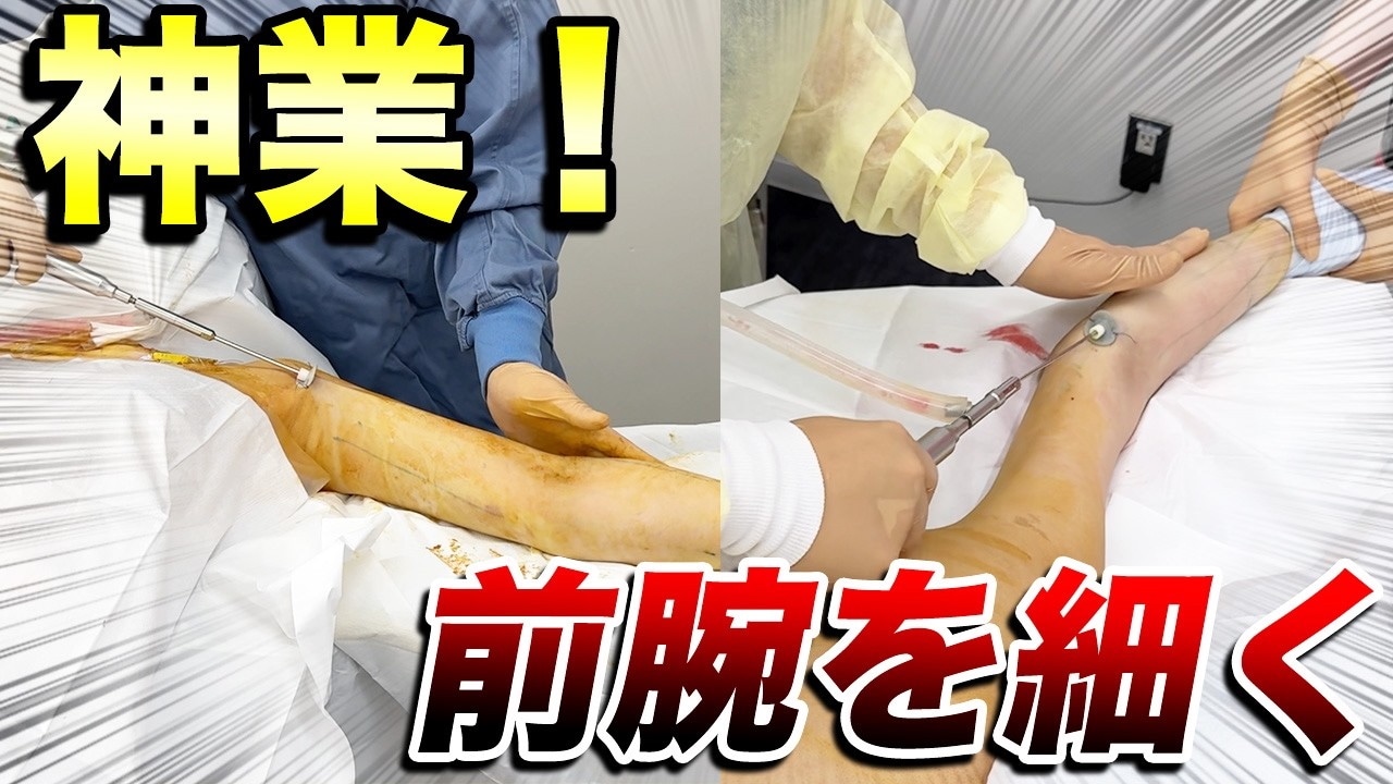 前腕の脂肪吸引が適応な人の特徴とは？セルフチェックなど詳しく解説！