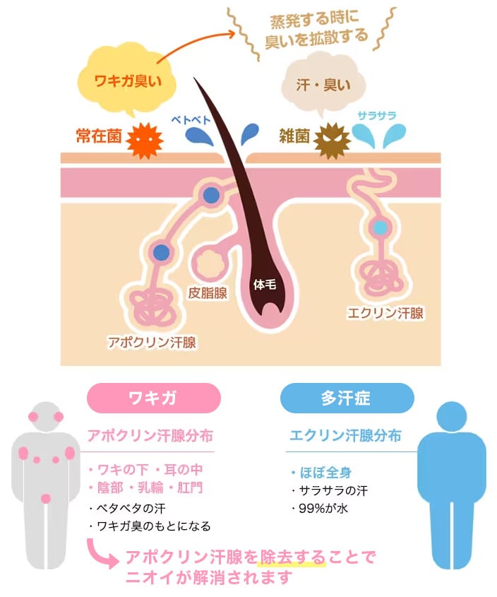 ワキガと汗のニオイは何が違うの？