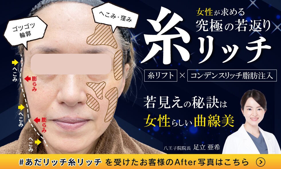 糸リッチ（糸リフトと脂肪注入）で女性らしい曲線美をつくる！究極の若返りを湘南美容クリニック八王子院で！