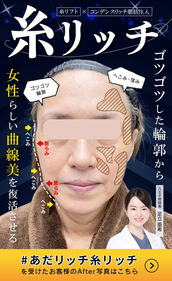糸リッチ（糸リフトと脂肪注入）で女性らしい曲線美をつくる！究極の若返りを湘南美容クリニック八王子院で！