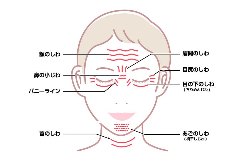 ボトックスで予防できるシワ