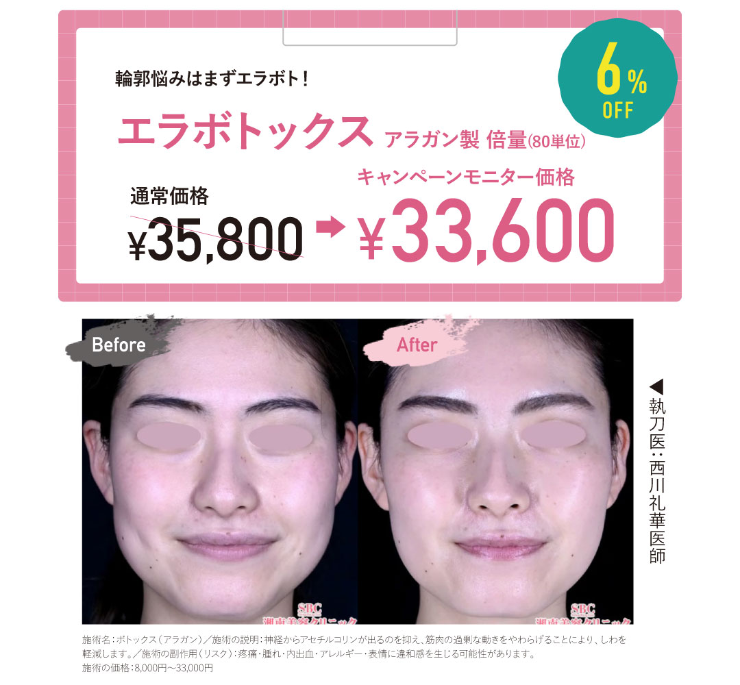 エラボトックス(80単位)