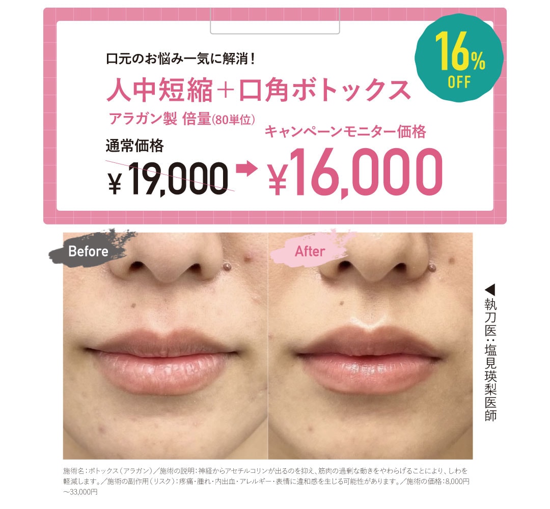 人中短縮+口角ボトックス