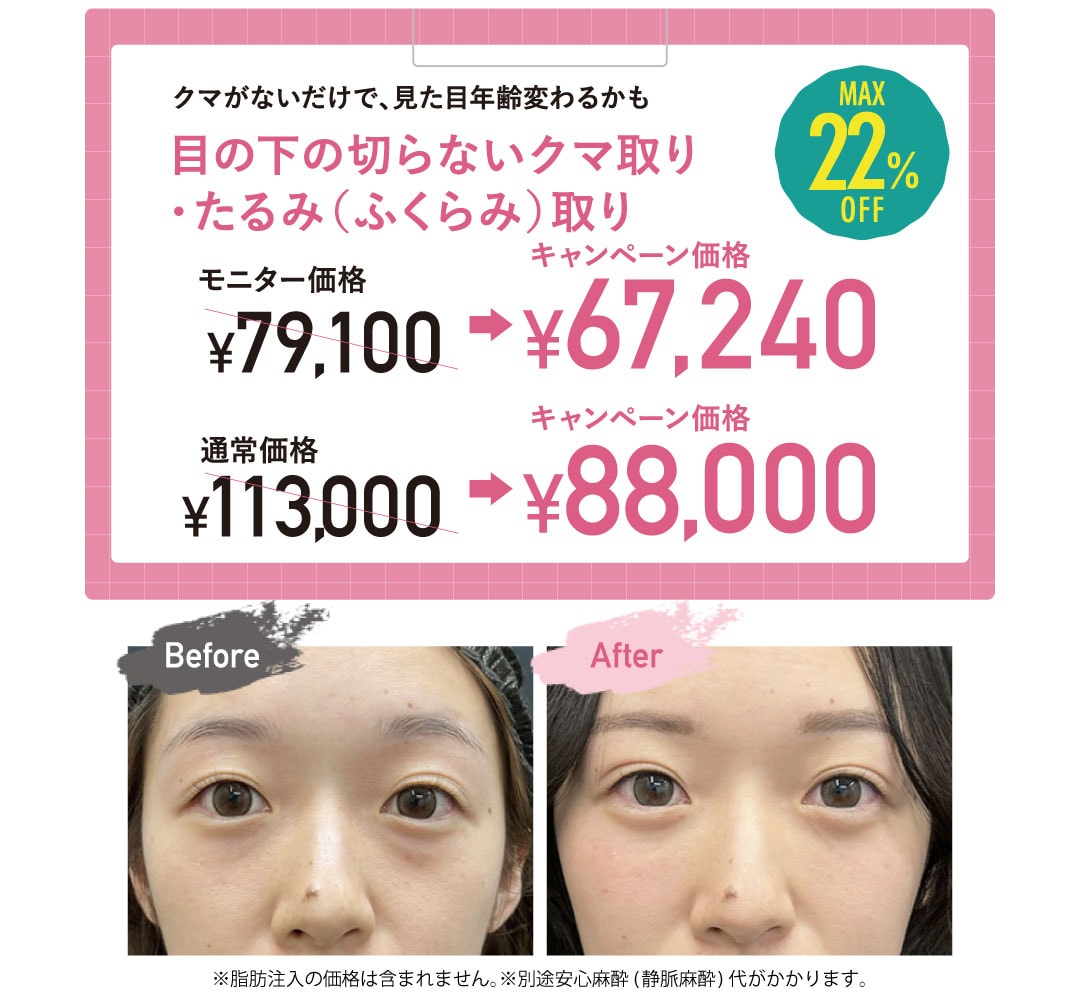 目の下の切らないクマ・たるみ(ふくらみ)取り