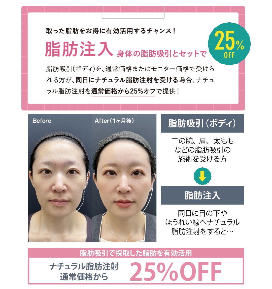脂肪注入