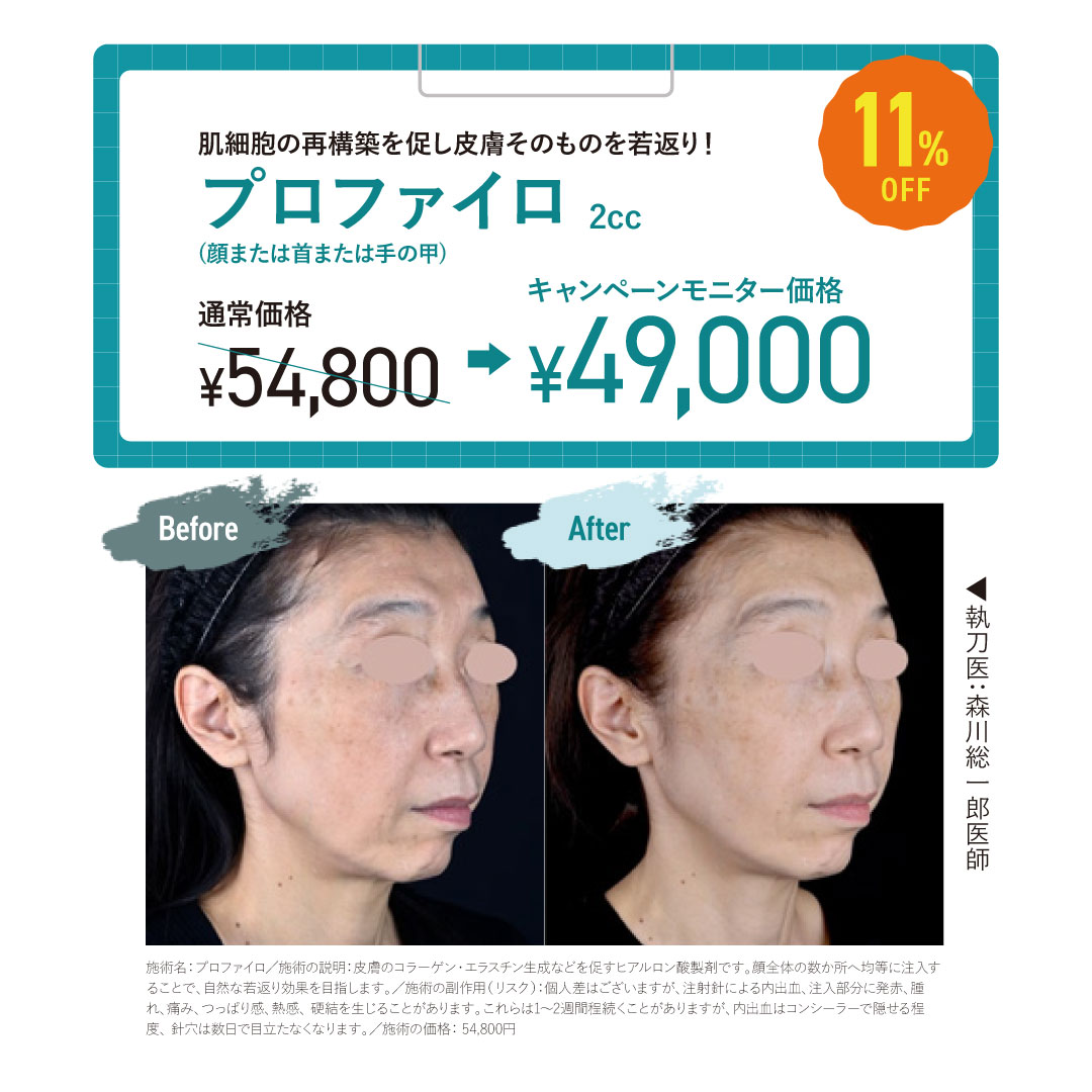 プロファイロ