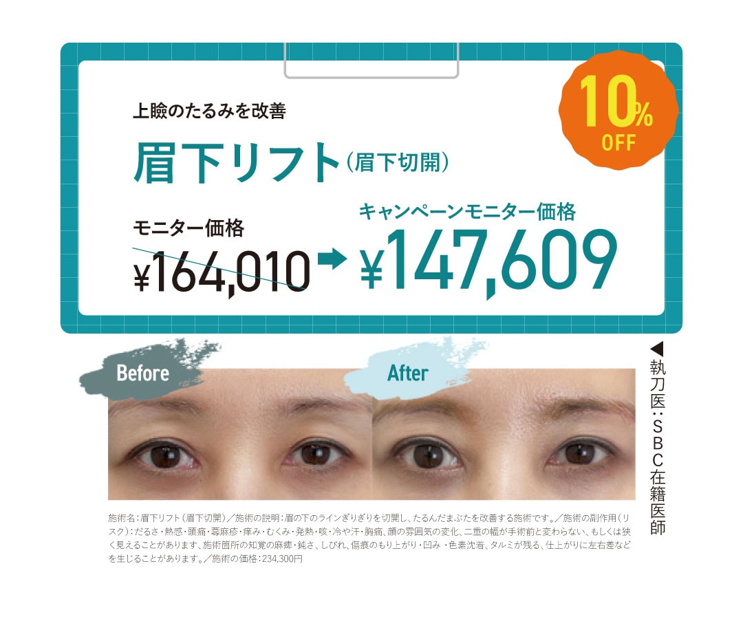 眉下リフト