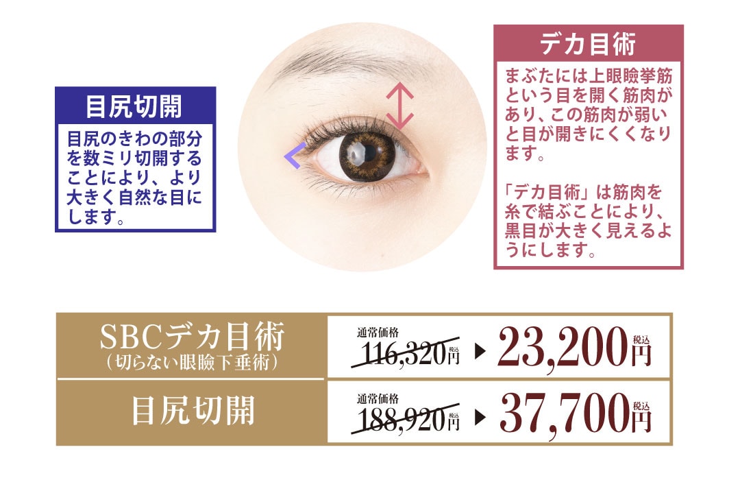 SBCデカ目術・目尻切開法