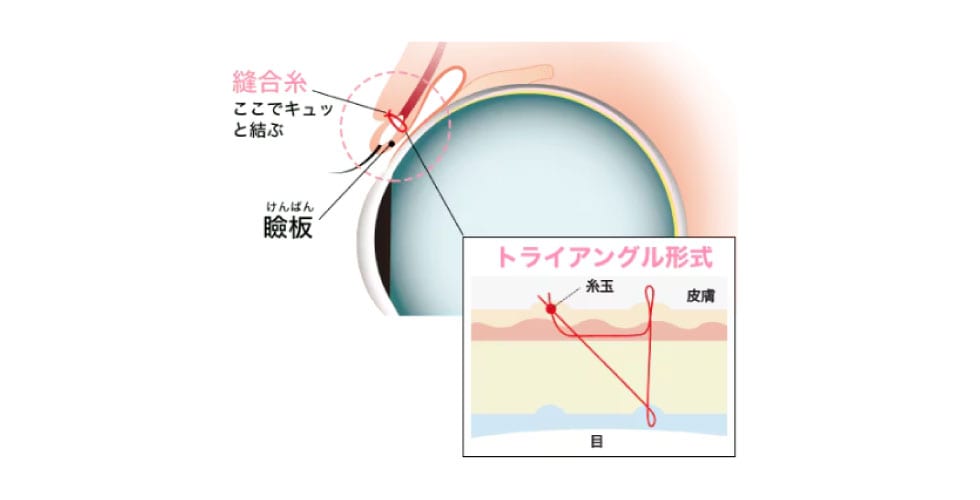 「Teen二重」はどんな施術？