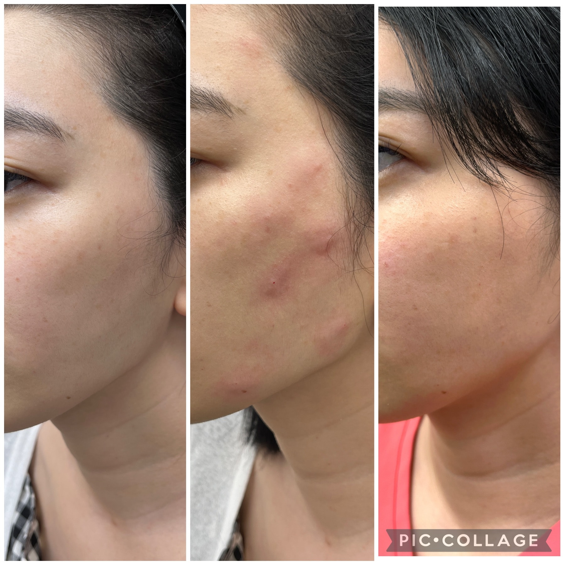 直後は虫刺されのような赤みが！