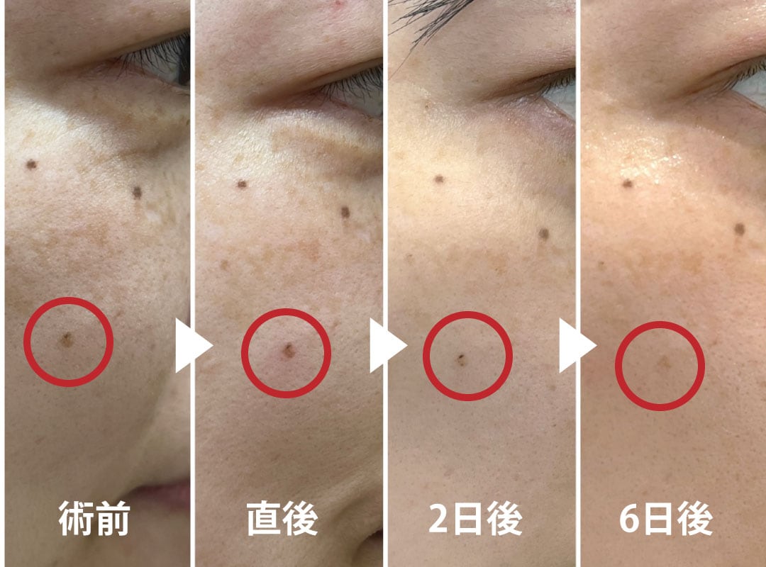 フォトトリプル】効果ない？本当にシミは消える？スタッフが検証 