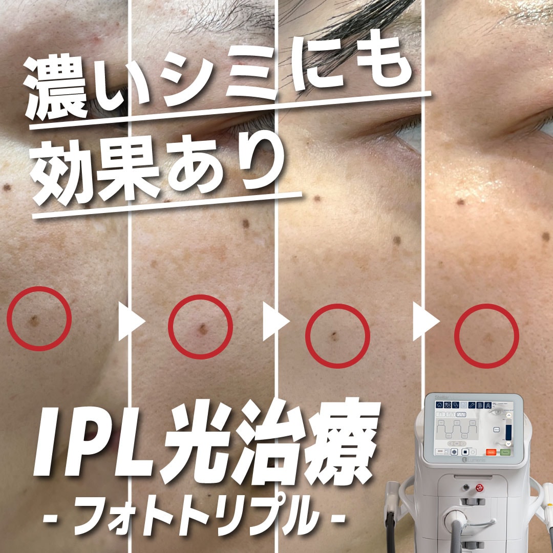 【フォトトリプル】本当にシミは消える？スタッフが検証！