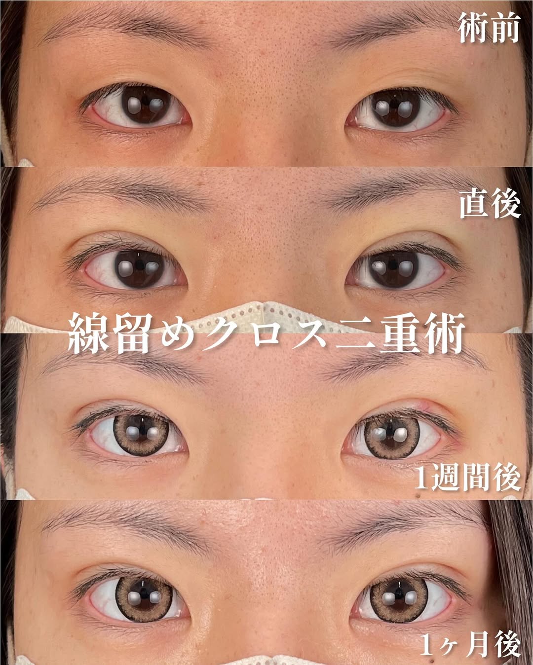 二重整形（埋没法・切開法）