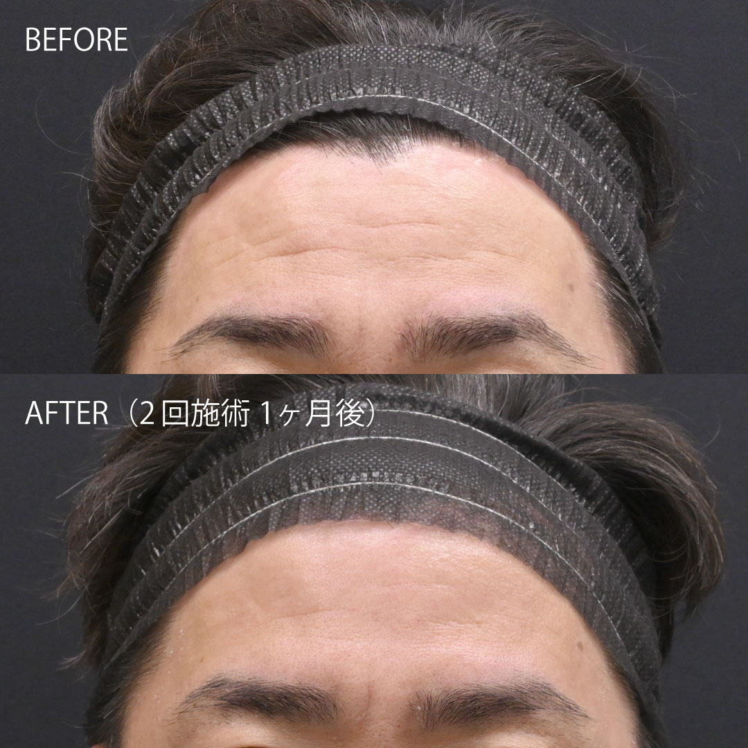 女優注射でおでこのシワが改善