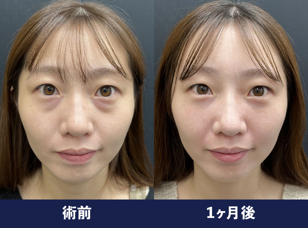 20代女性【裏ハムラ法】