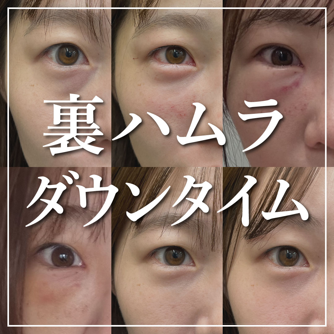 【クマ治療】裏ハムラ法のダウンタイムお見せします