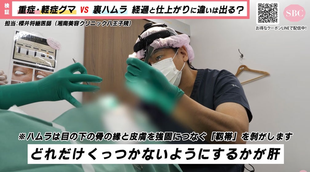櫻井院長流・裏ハムラ法のポイントは？