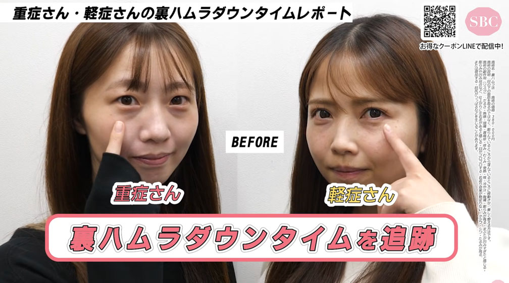 ダウンタイムに密着