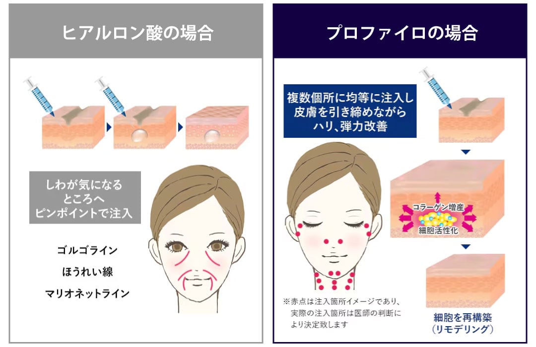 従来のヒアルロン酸と何が違うのですか？
