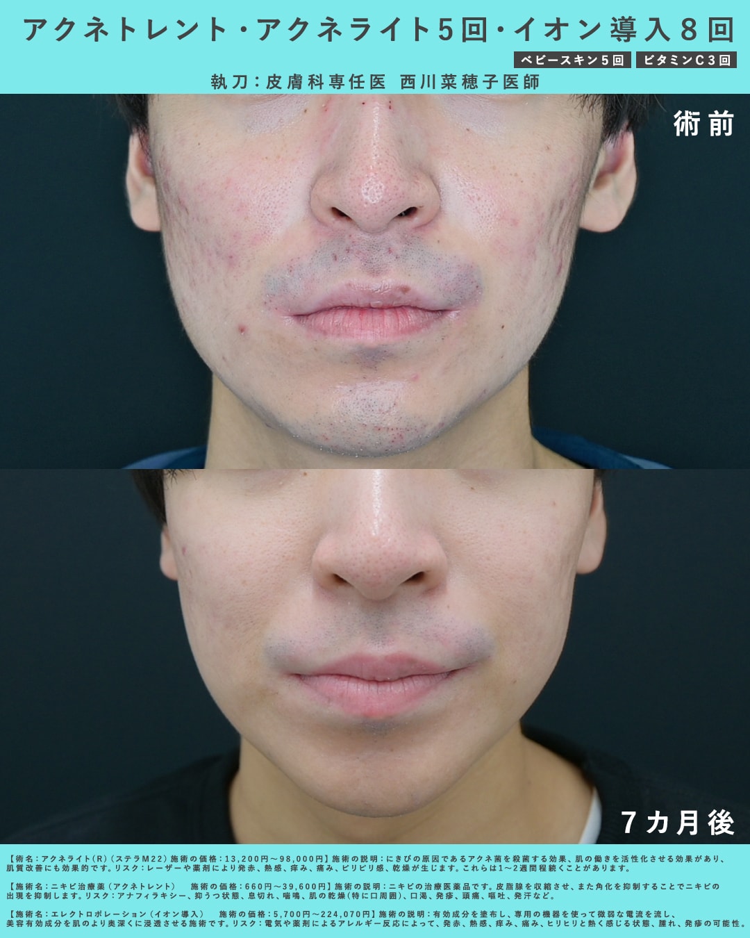 福岡 皮膚 科 ニキビ