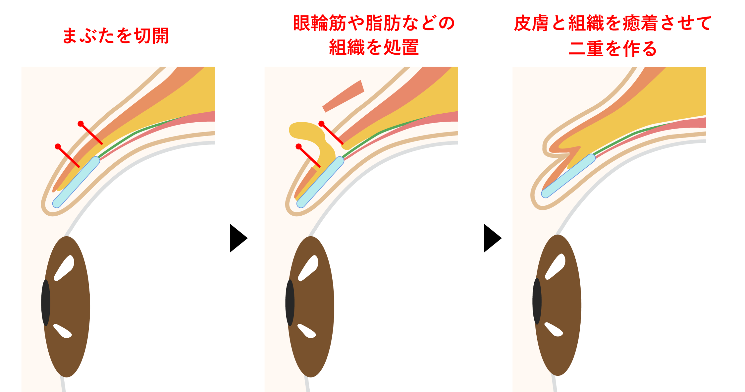 全切開法二重術
