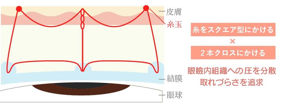 線留めクロス二重術
