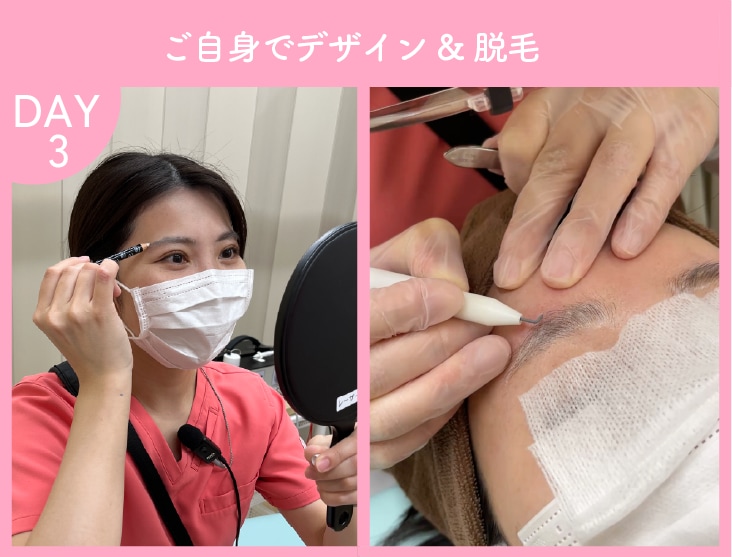 ニードル脱毛施術