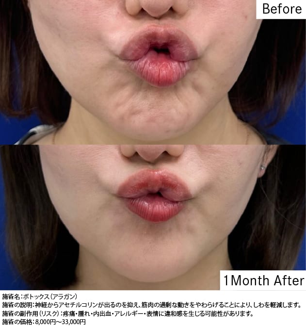 アゴボトックスで梅干しジワ解消