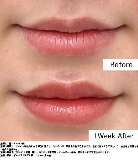 唇への注入でEラインも整う