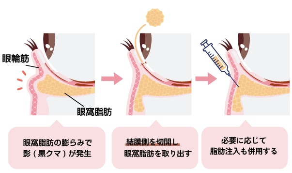目の下の切らないクマ・たるみ取り(経結膜脱脂法)