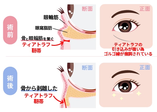 ティアトラフ靭帯の正しい剥離