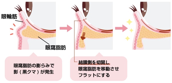 裏ハムラ法とは