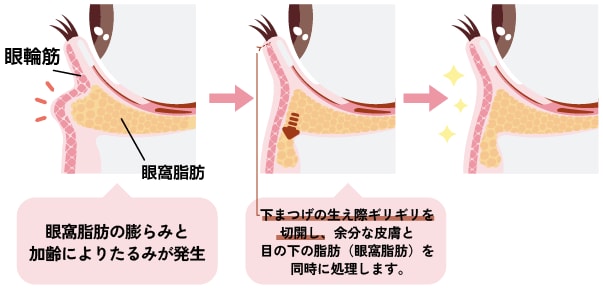 切開ハムラ法