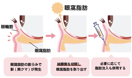 目の下の切らないクマ・たるみ取り（経結膜脱脂法）