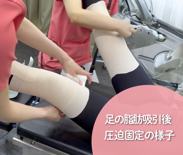 脂肪吸引後の圧迫固定はどのくらいの期間必要ですか?