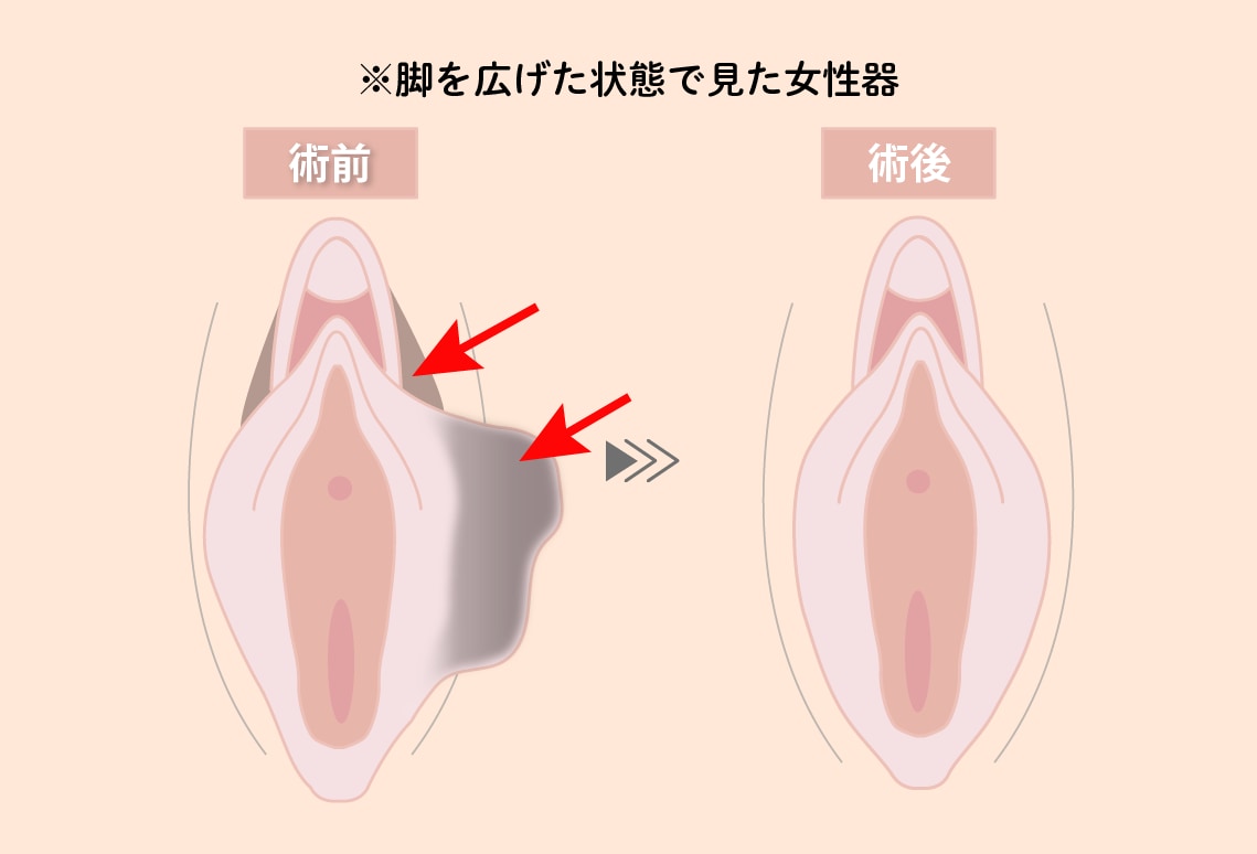 左右差がある方<br />