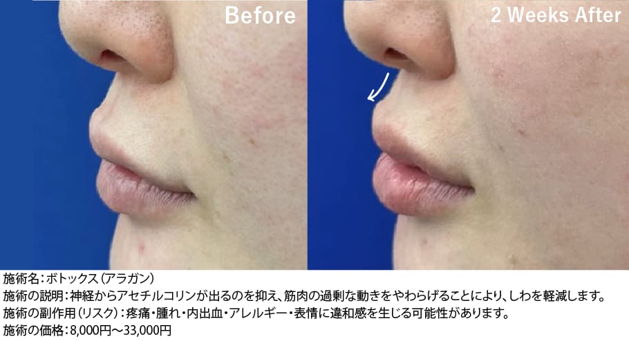 唇への注入でEラインも整う