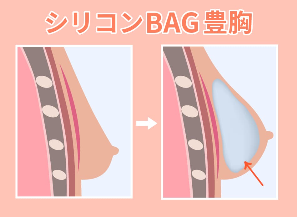 シリコンBAG豊胸