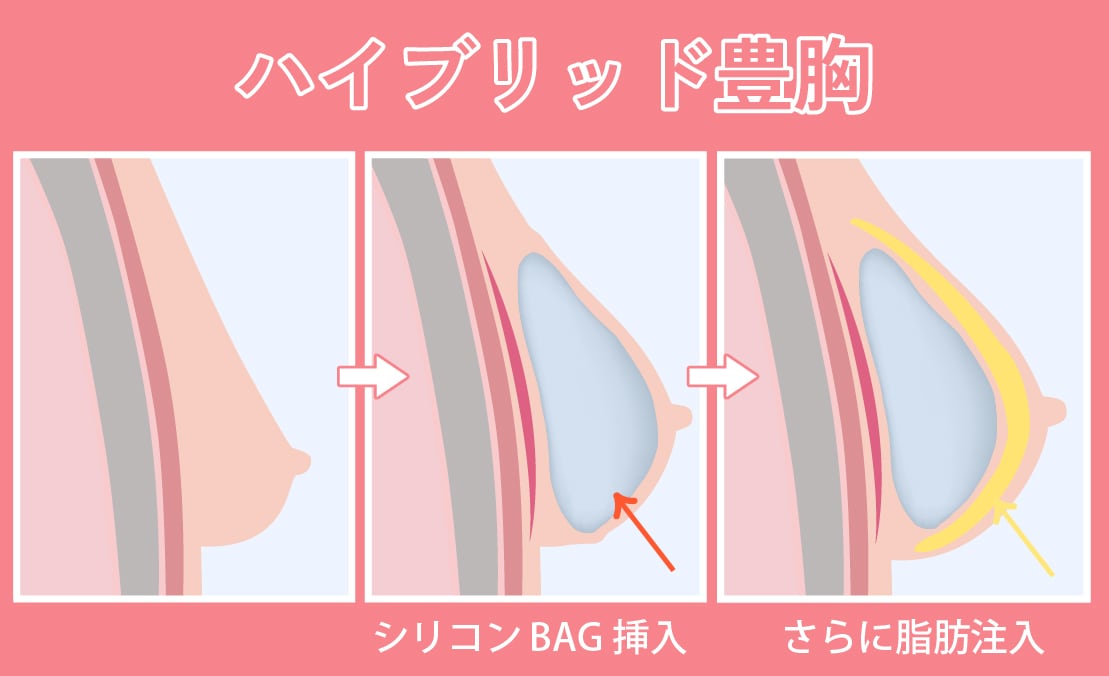 ハイブリッド豊胸(脂肪注入＋シリコンBAG)