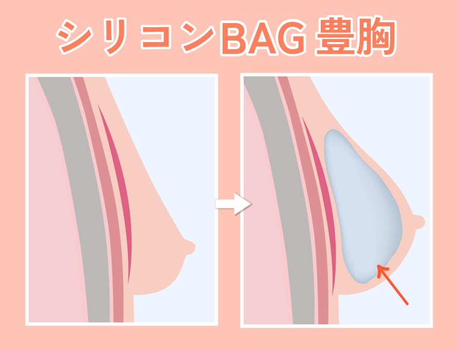 シリコンBAG豊胸