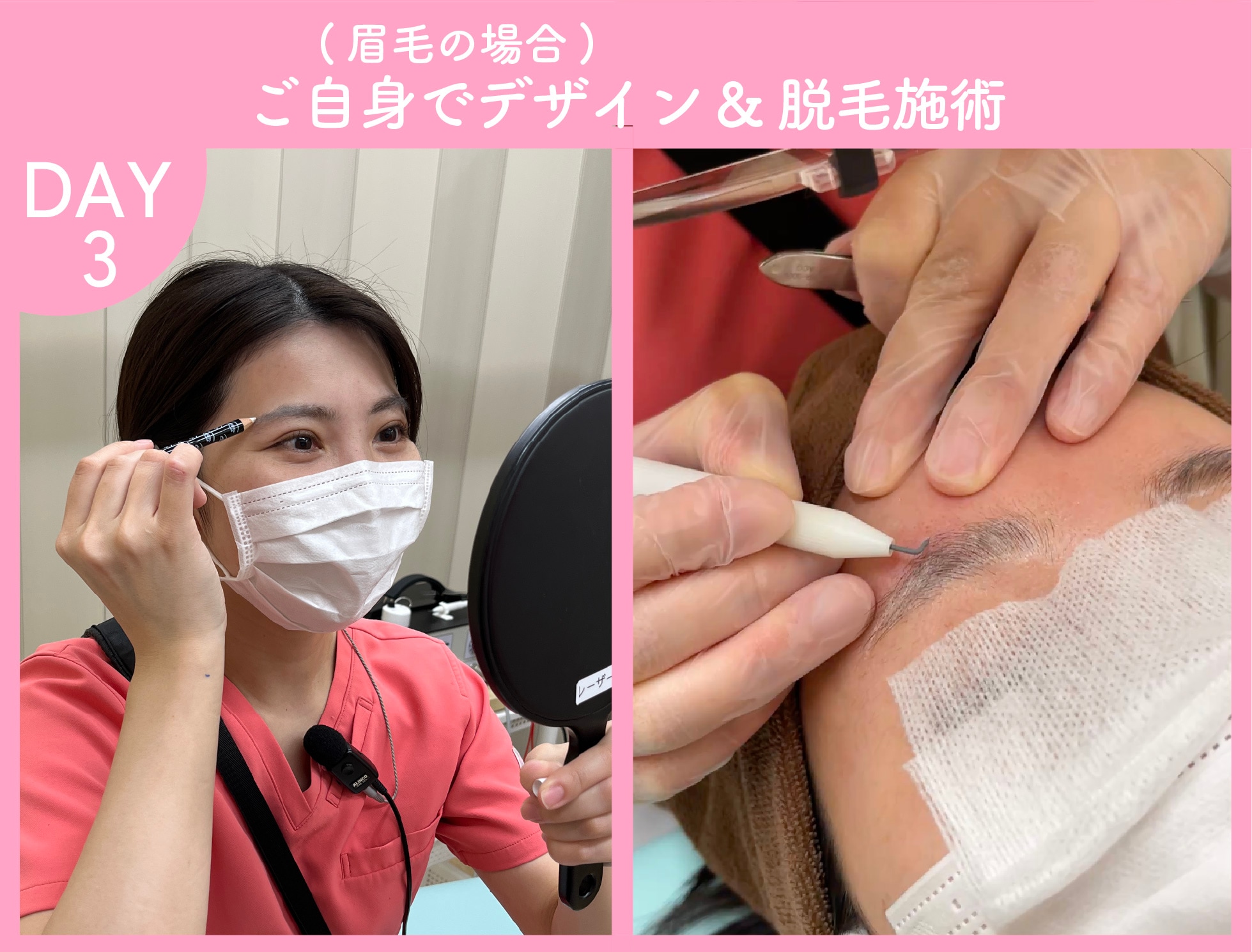 ニードル脱毛施術
