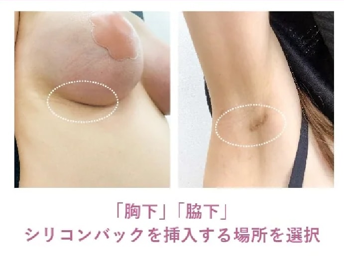 選べる！傷跡の場所