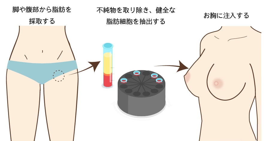 脂肪注入豊胸とは?