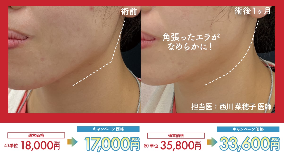 エラボトックス